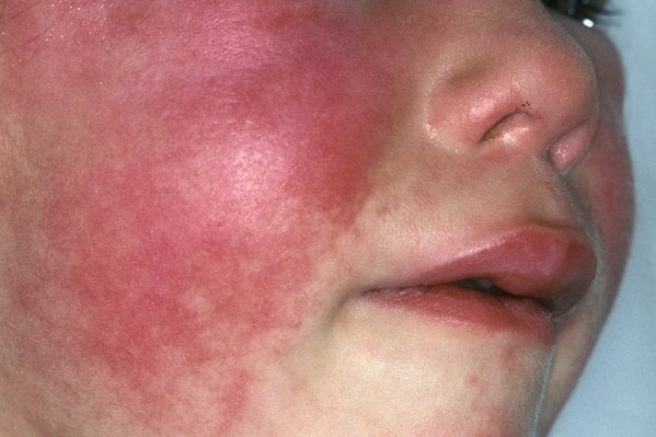 A scarlet fever rash