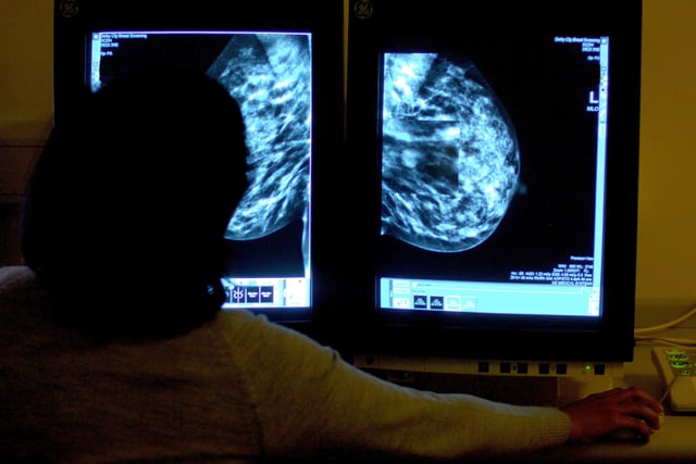 Hundreds of 'missing' cancer diagnoses in Bath and north east Somerset, Swindon and Wiltshire in 2020 – as fewer found at early stage