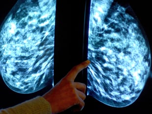 Breast screening uptake in Bristol, north Somerset and south Gloucestershire remains below pre-pandemic levels