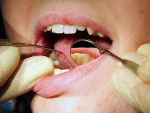 Nearly a third of people in Bath and North East Somerset, Swindon and Wiltshire struggle to get an NHS dentist appointment