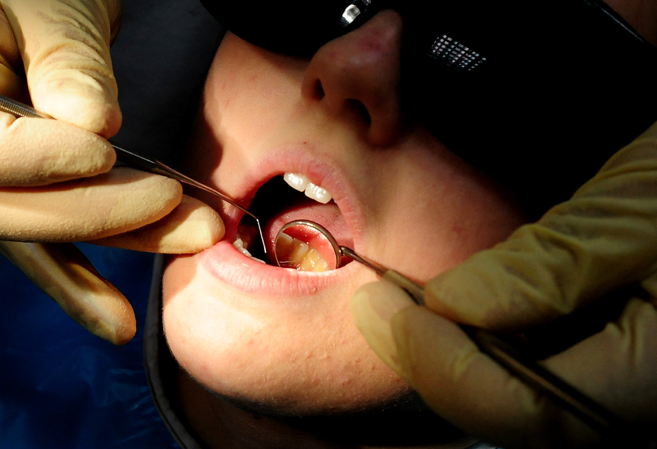 More than a quarter of children have rotting teeth in North Somerset