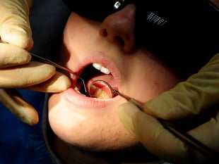 More than a quarter of children have rotting teeth in North Somerset