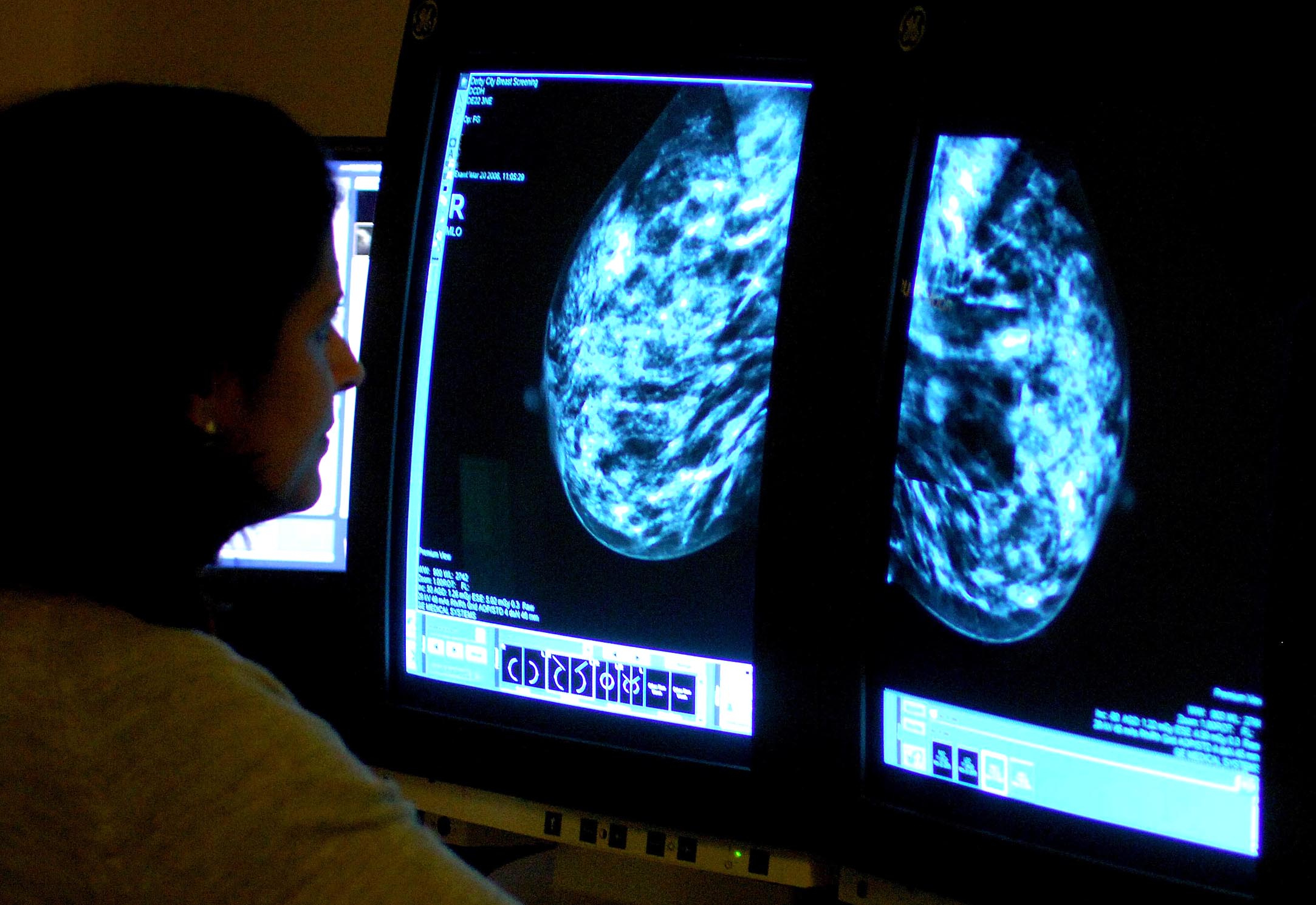 More women in North Somerset undergo breast cancer screening – as NHS England target met for first in five years