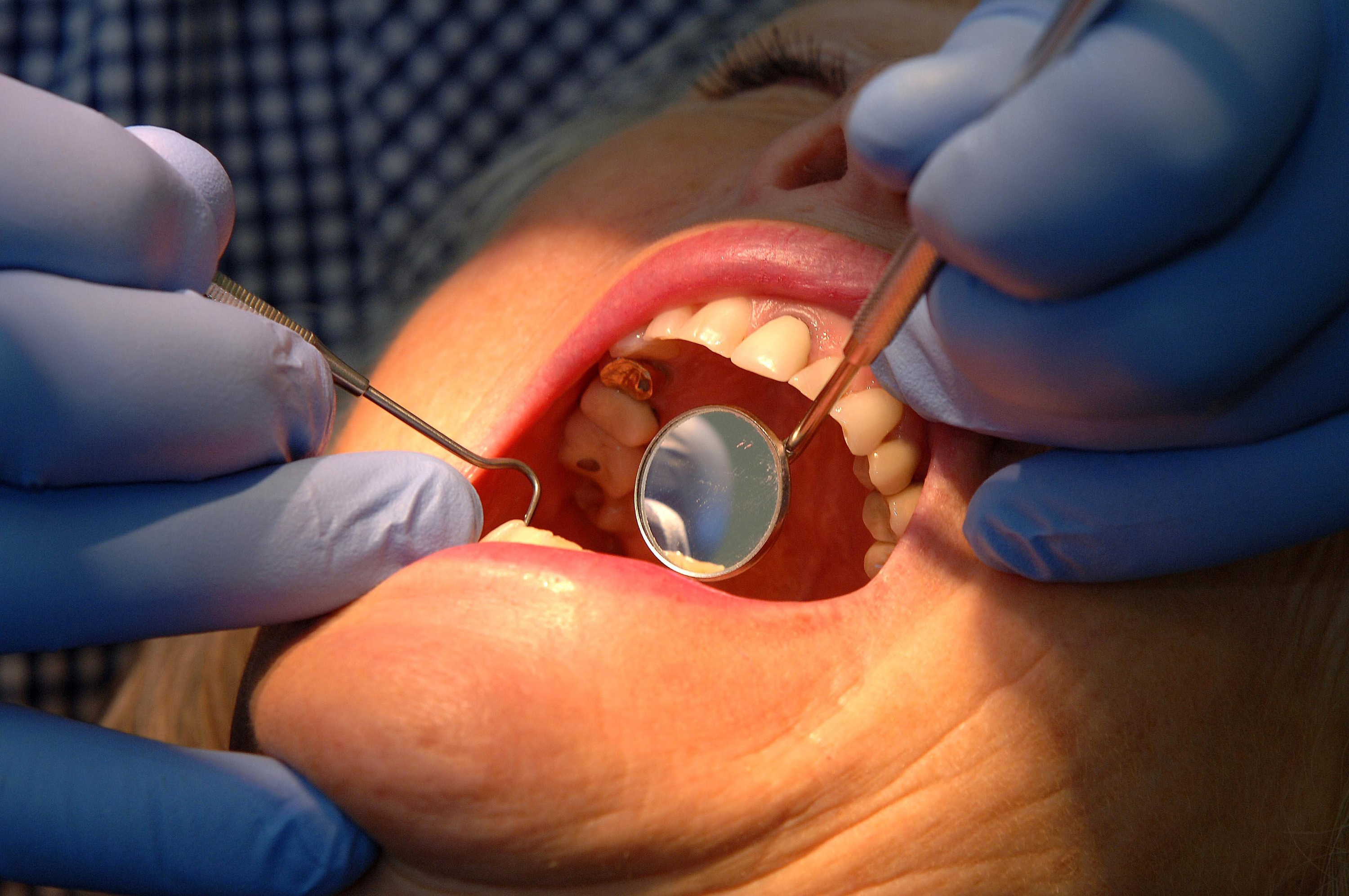  People in Bristol, north Somerset and South Gloucestershire more likely to have access to an NHS dentist – as 'postcode lottery' sees thousands miss out